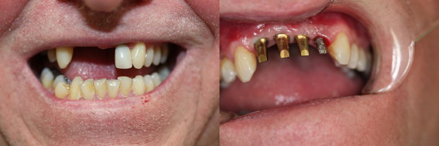 Implant_before2.jpg