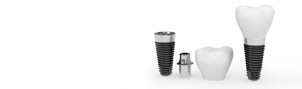 dental-implants.jpg